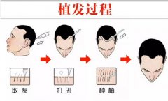 植发费用怎么算，广州植发医院种植3000个单位要多少钱?