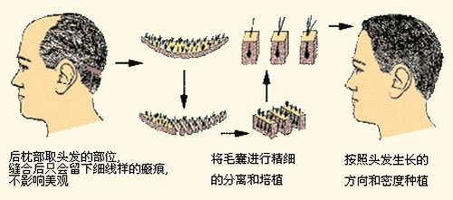 种植头发原理