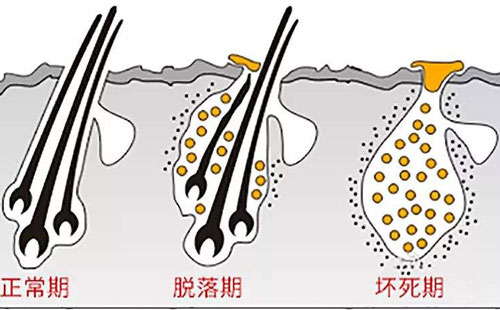 种植头发问题