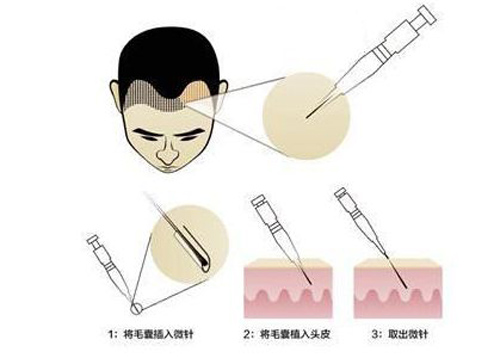 微针植发那么贵，为什么还要选择它？