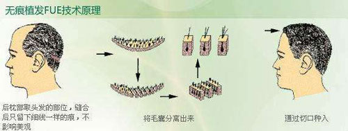 瑞士NAT美学种植头发