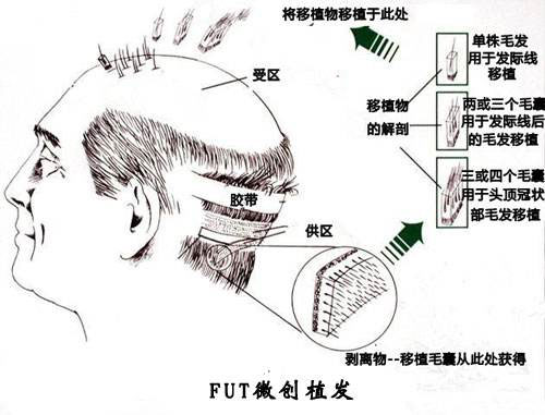 发际线种植