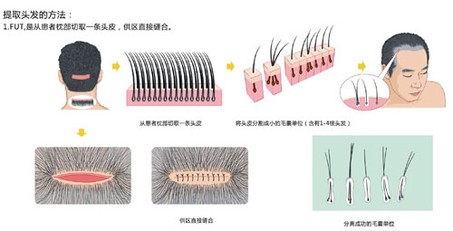 种植头发靠谱吗?