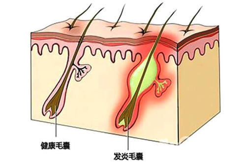 NAT生态美学种植头发