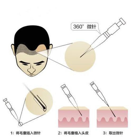 SEP超级微针种植头发