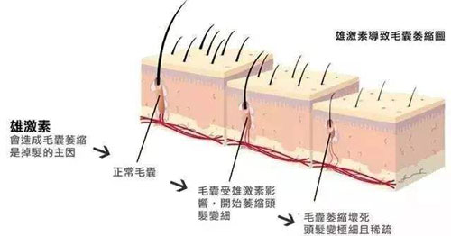 雄激素脱发,